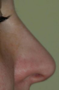 ricostruzione punta del naso